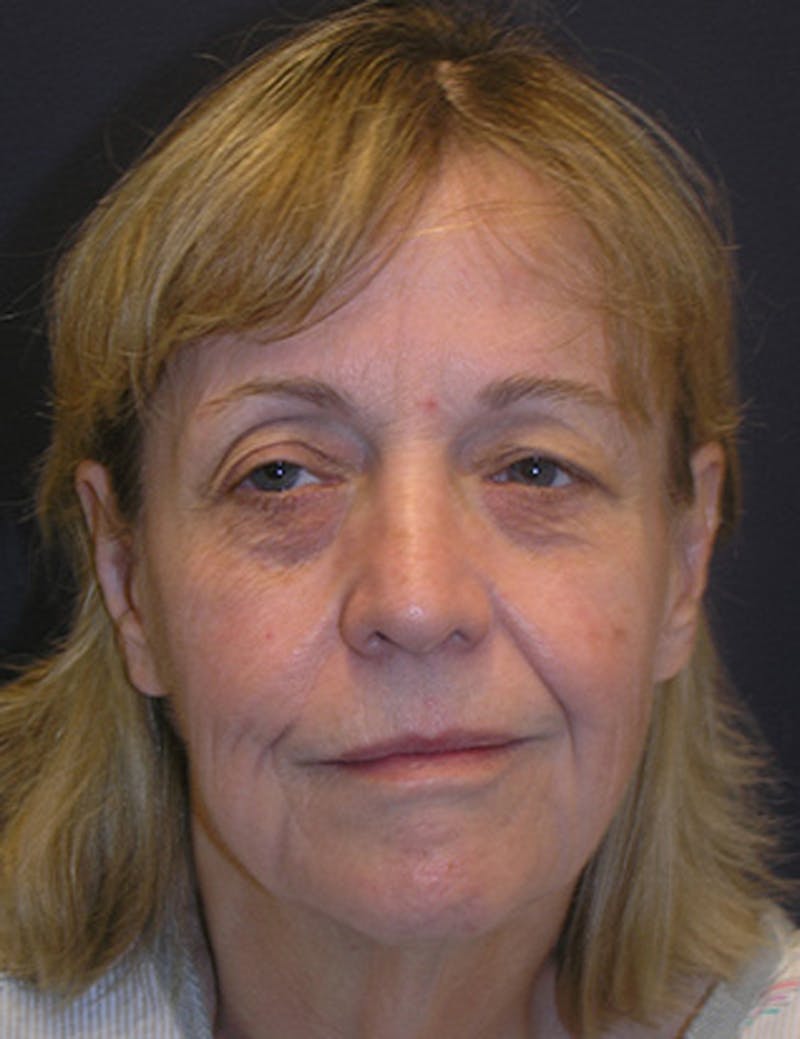 Facelift Before & After Gallery - Patient 174146503 - Image 1