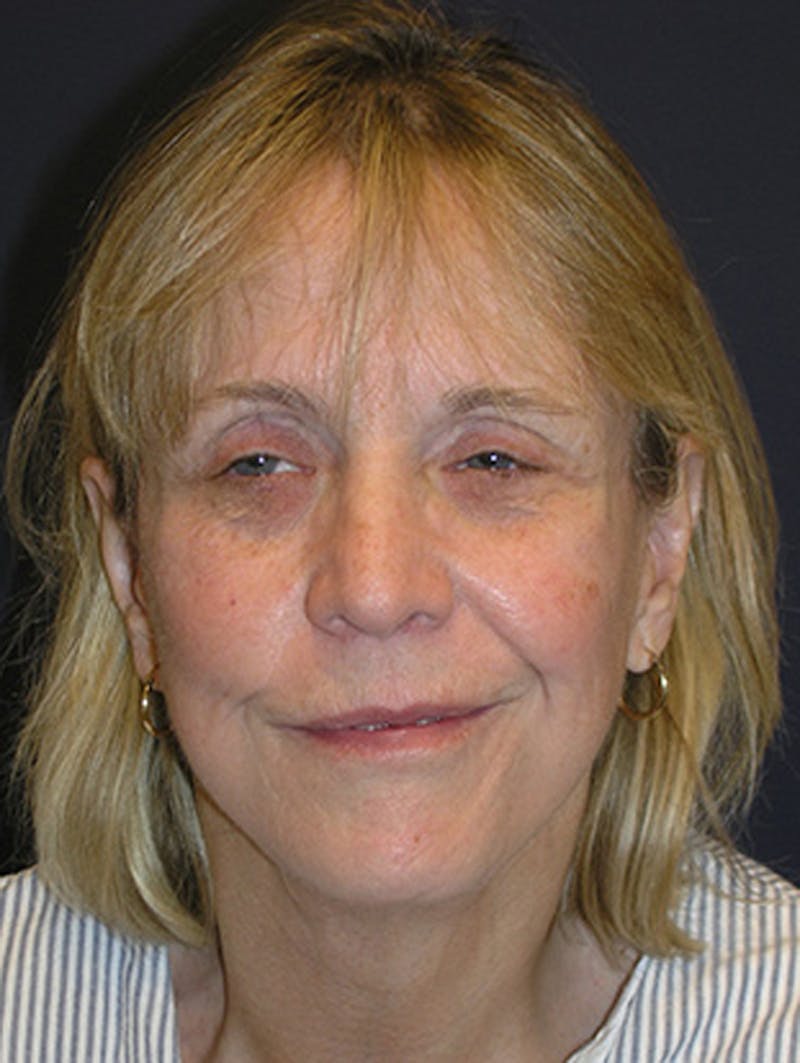 Facelift Before & After Gallery - Patient 174146503 - Image 2