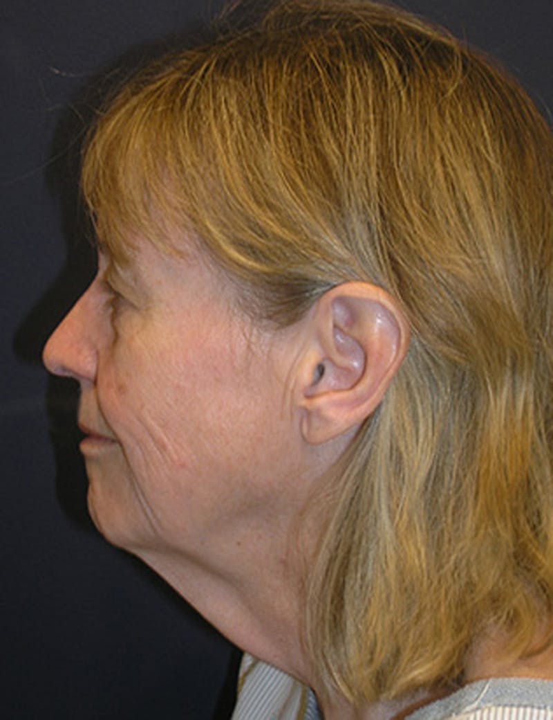 Facelift Before & After Gallery - Patient 174146503 - Image 3