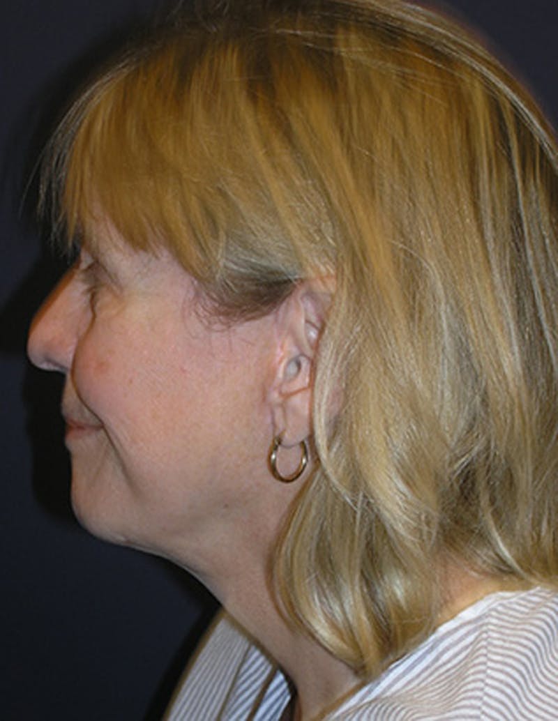 Facelift Before & After Gallery - Patient 174146503 - Image 4