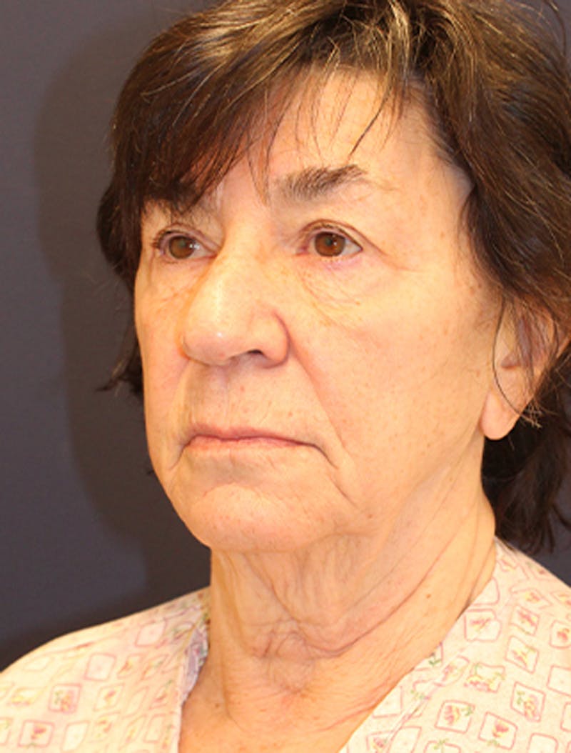 Facelift Before & After Gallery - Patient 174146508 - Image 3