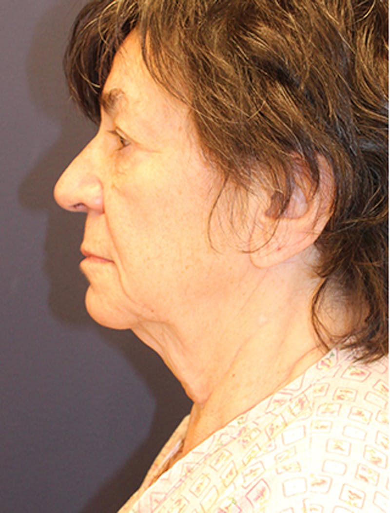 Facelift Before & After Gallery - Patient 174146508 - Image 5