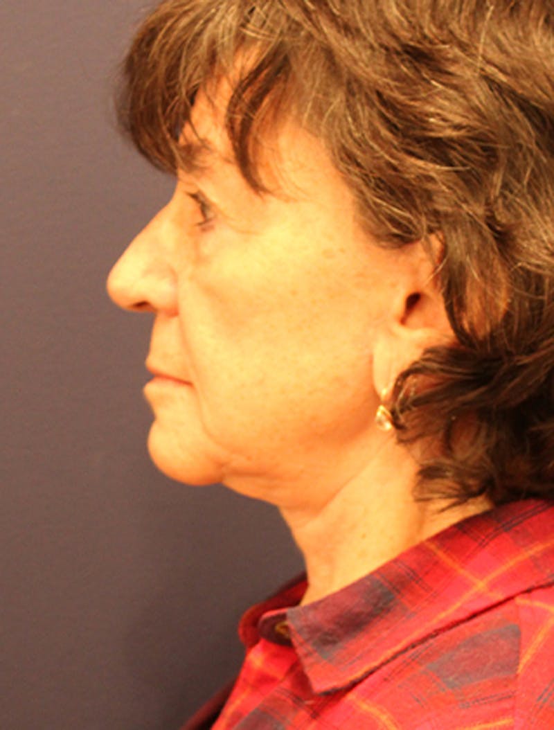 Necklift Before & After Gallery - Patient 417679 - Image 6