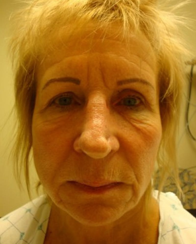 Facelift Before & After Gallery - Patient 174146513 - Image 1