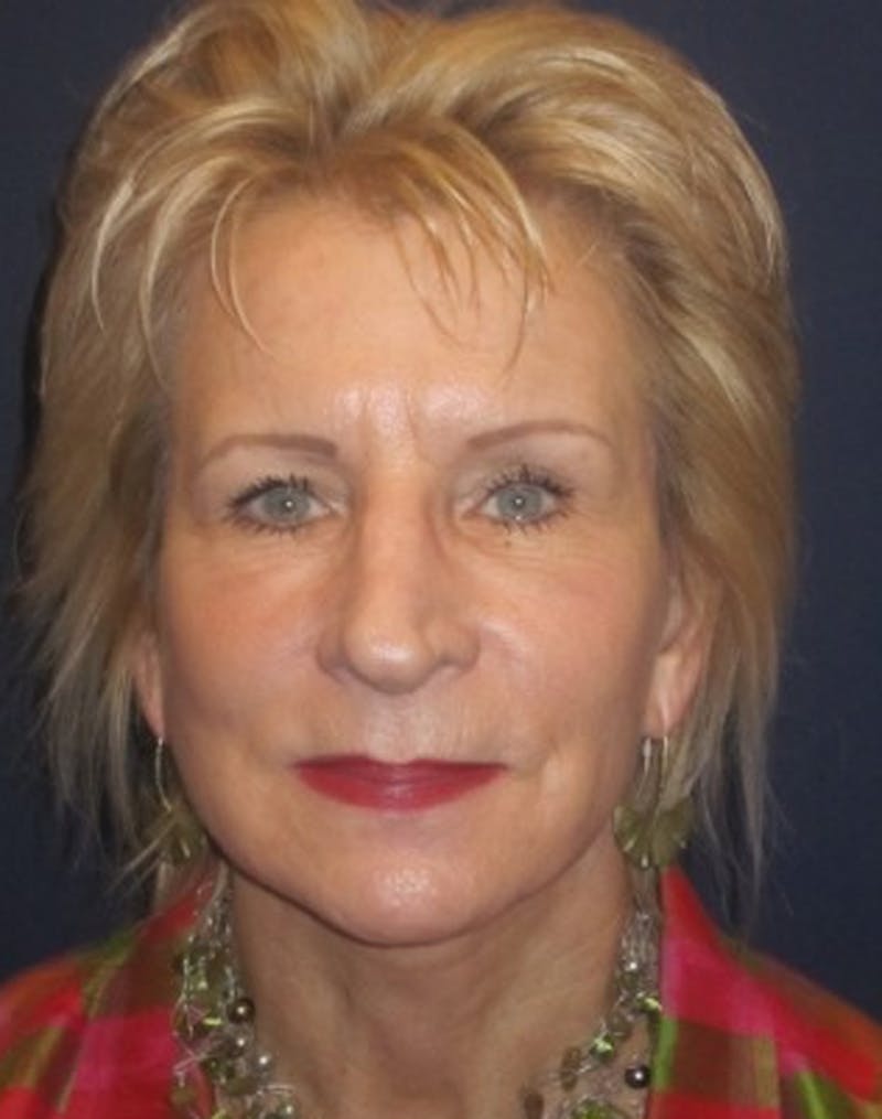 Facelift Before & After Gallery - Patient 174146513 - Image 2