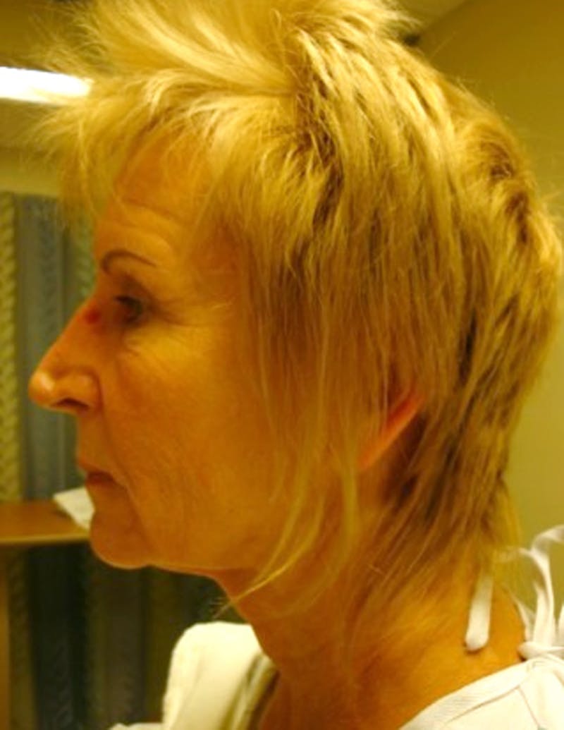 Facelift Before & After Gallery - Patient 174146513 - Image 3
