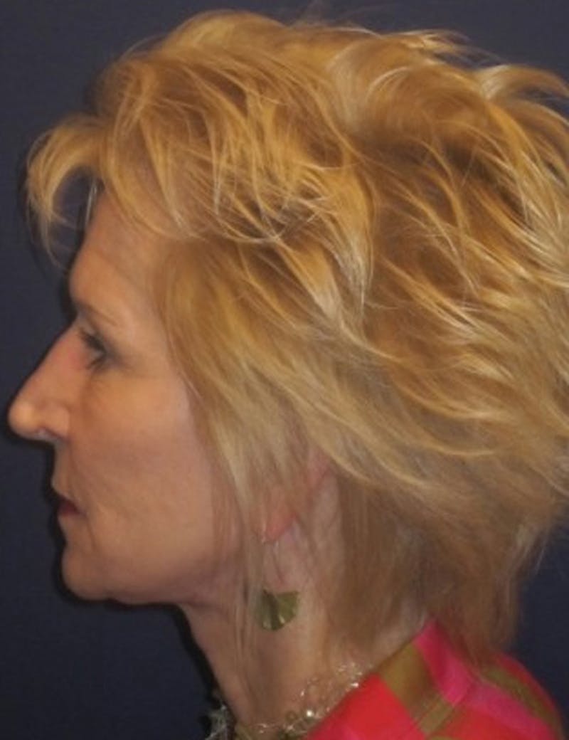 Facelift Before & After Gallery - Patient 174146513 - Image 4