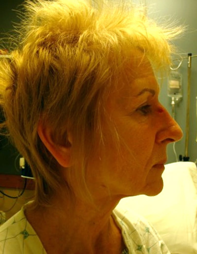 Facelift Before & After Gallery - Patient 174146513 - Image 5