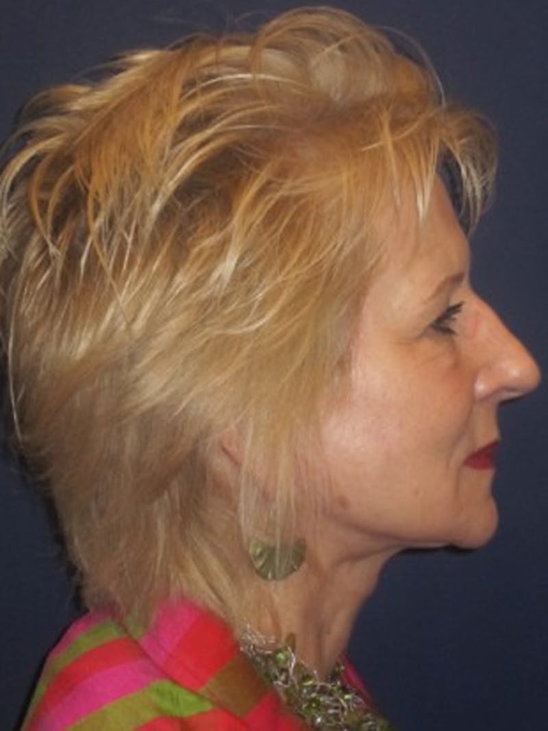 Facelift Before & After Gallery - Patient 174146513 - Image 6