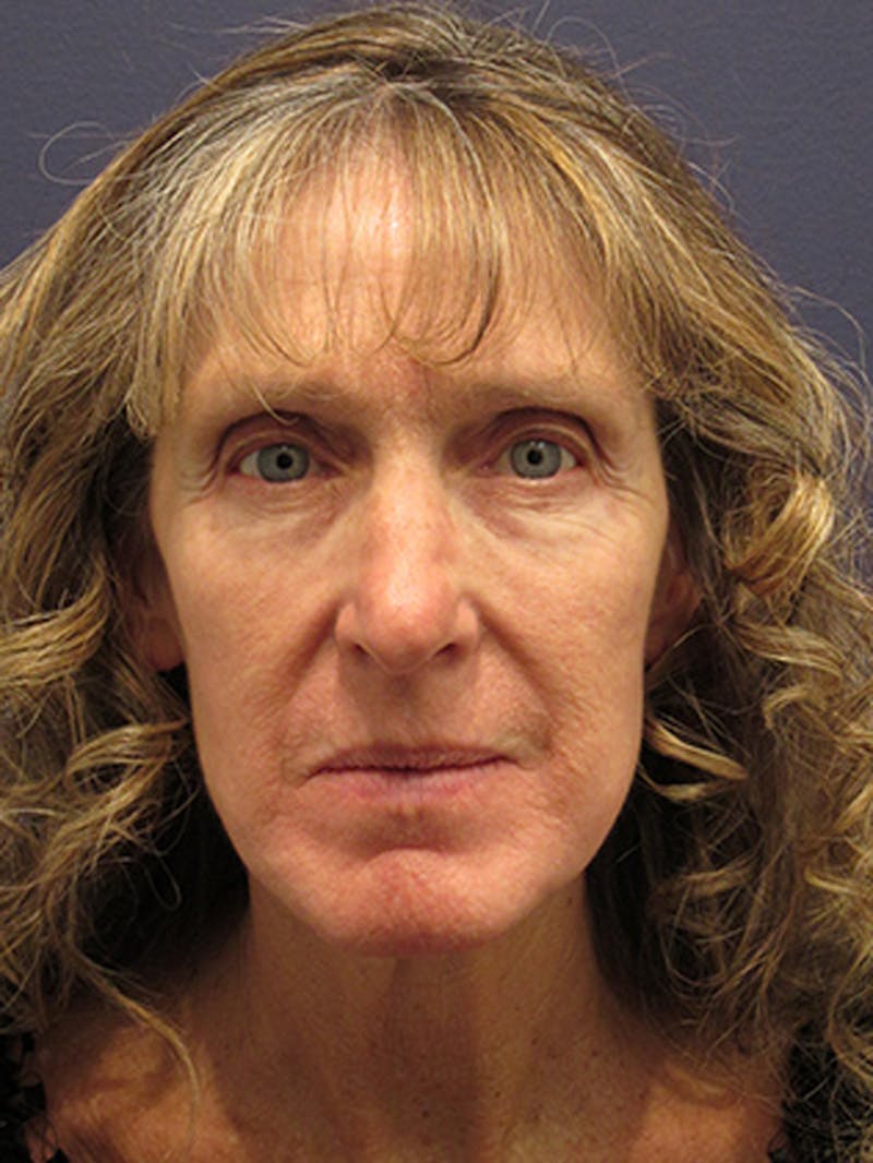 Facelift Before & After Gallery - Patient 174146518 - Image 1