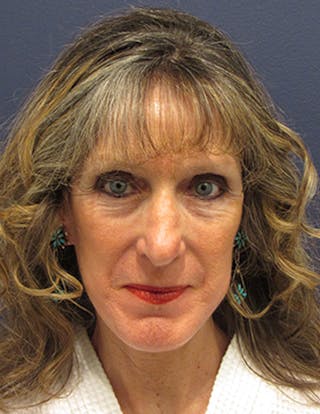 Facelift Before & After Gallery - Patient 174146518 - Image 2