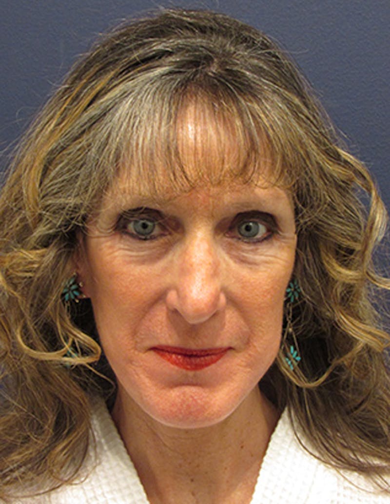 Facelift Before & After Gallery - Patient 174146518 - Image 2