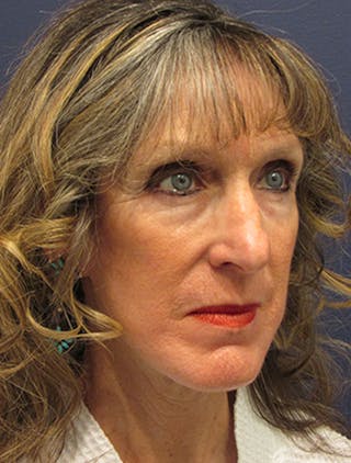 Facelift Before & After Gallery - Patient 174146518 - Image 4