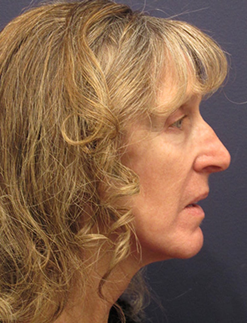 Facelift Before & After Gallery - Patient 174146518 - Image 5