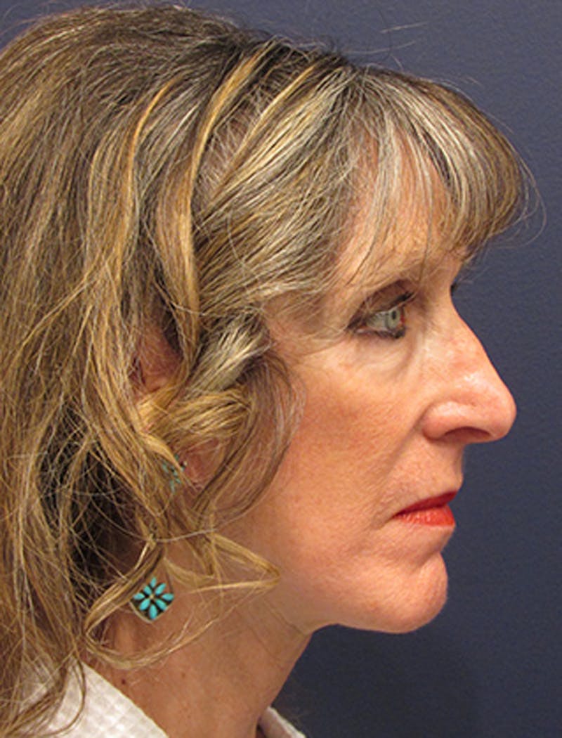 Facelift Before & After Gallery - Patient 174146518 - Image 6