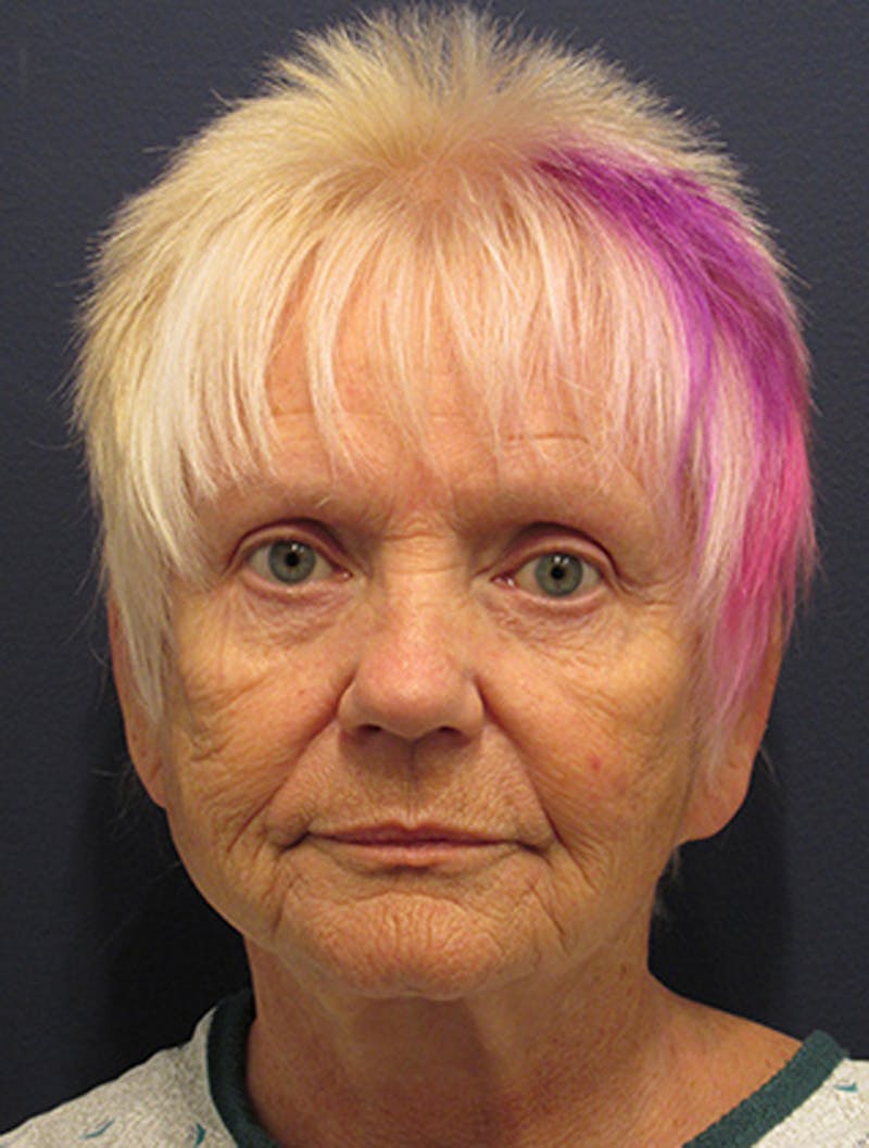 Facelift Before & After Gallery - Patient 174146521 - Image 1