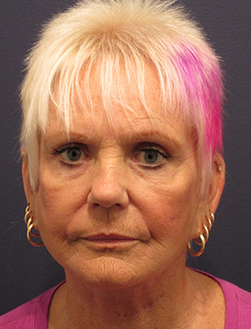 Facelift Before & After Gallery - Patient 174146521 - Image 2