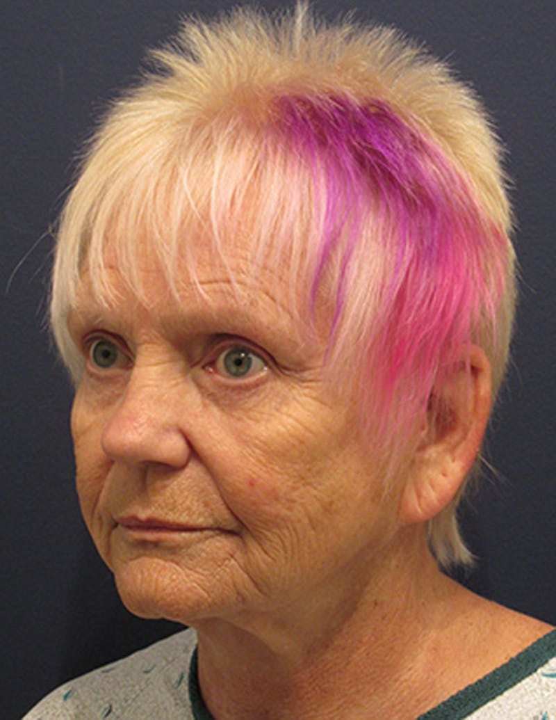Facelift Before & After Gallery - Patient 174146521 - Image 3
