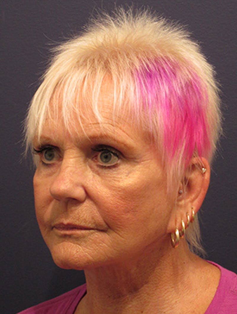 Facelift Before & After Gallery - Patient 174146521 - Image 4