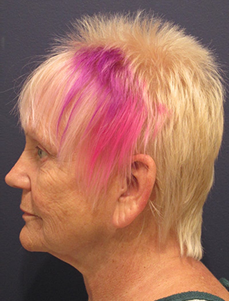 Facelift Before & After Gallery - Patient 174146521 - Image 5