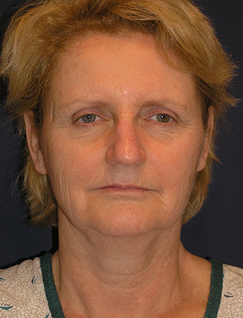 Facelift Before & After Gallery - Patient 174146526 - Image 1