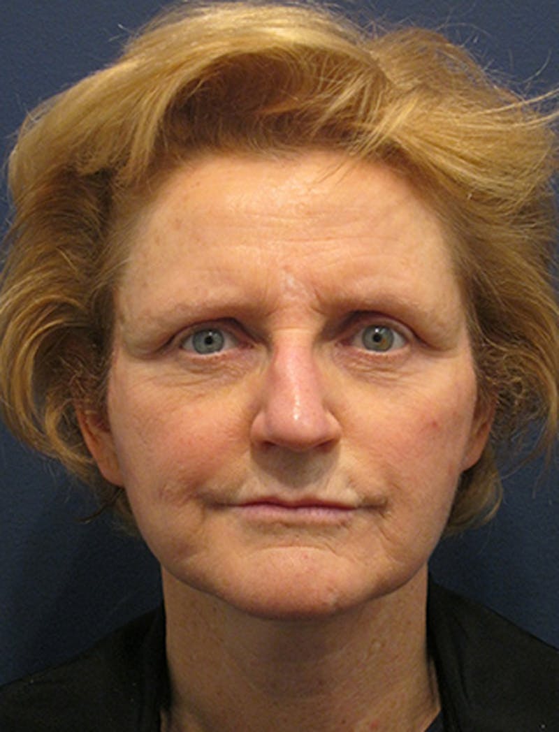 Facelift Before & After Gallery - Patient 174146526 - Image 2