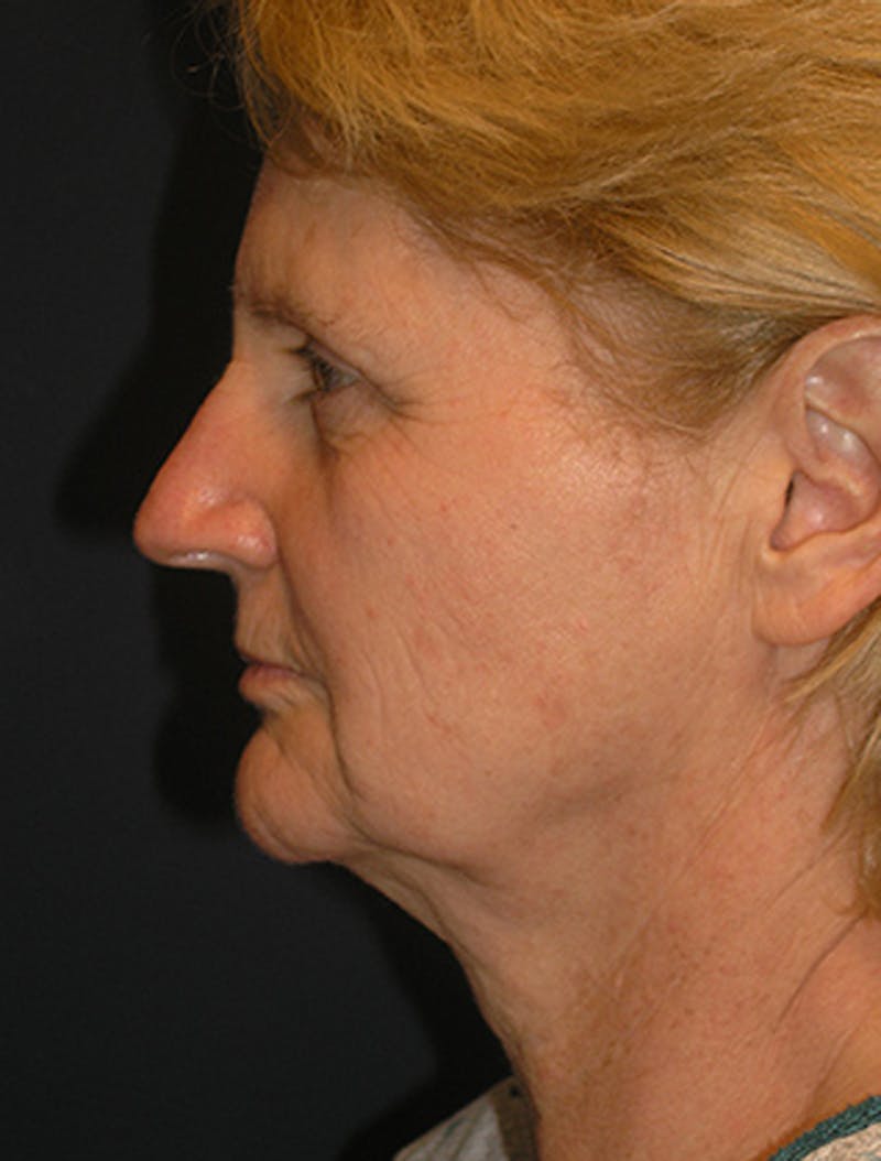 Facelift Before & After Gallery - Patient 174146526 - Image 5