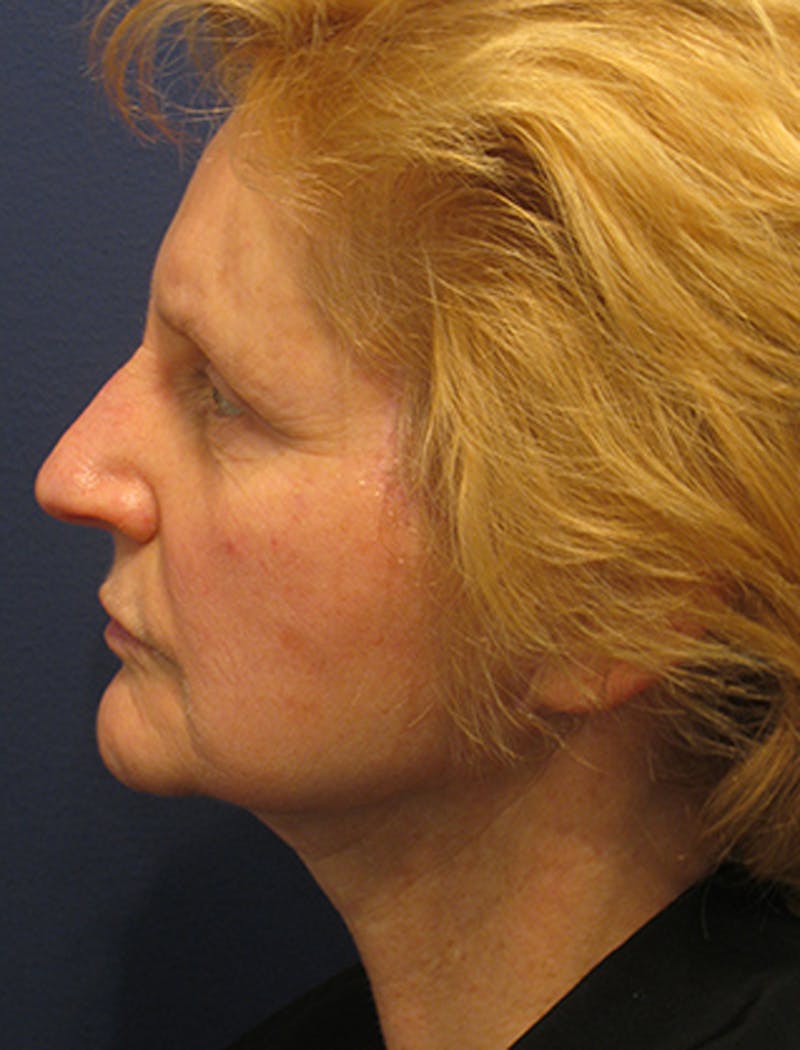Facelift Before & After Gallery - Patient 174146526 - Image 6
