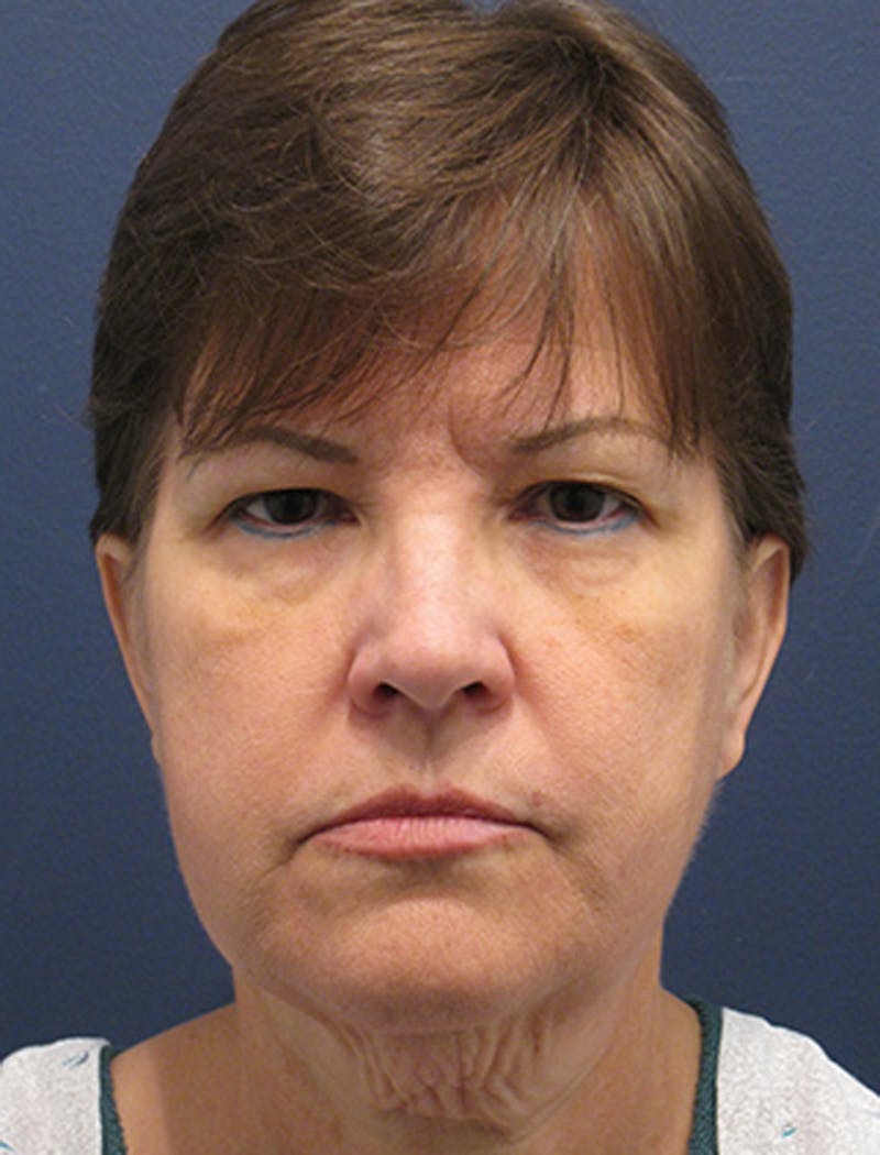 Facelift Before & After Gallery - Patient 174146529 - Image 1
