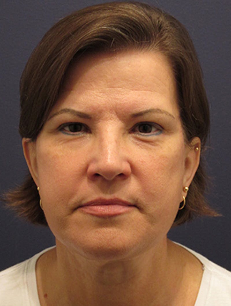 Facelift Before & After Gallery - Patient 174146529 - Image 2