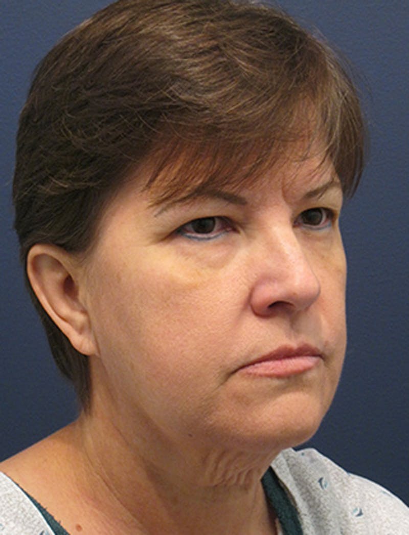 Facelift Before & After Gallery - Patient 174146529 - Image 3