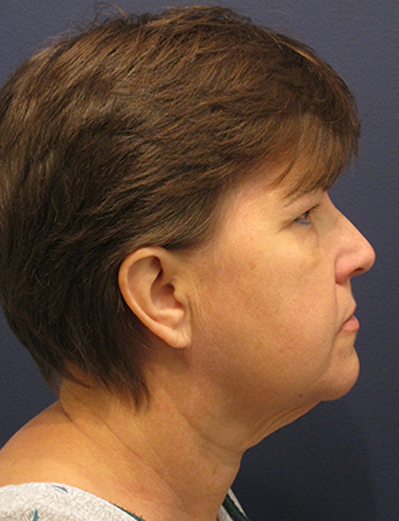 Facelift Before & After Gallery - Patient 174146529 - Image 5