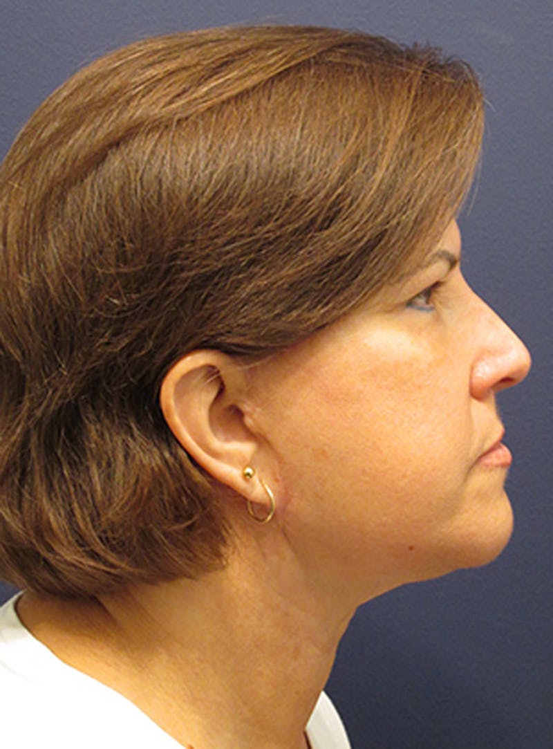 Facelift Before & After Gallery - Patient 174146529 - Image 6