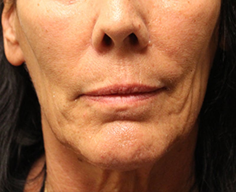 Facelift Before & After Gallery - Patient 174146554 - Image 1