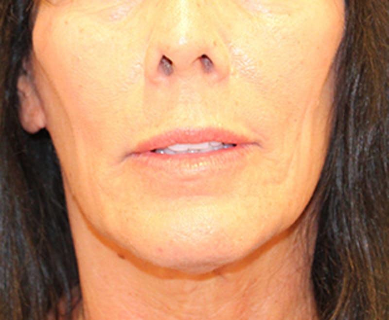 Facelift Before & After Gallery - Patient 174146554 - Image 2
