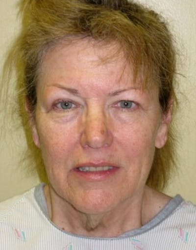 Facelift Before & After Gallery - Patient 174146556 - Image 1