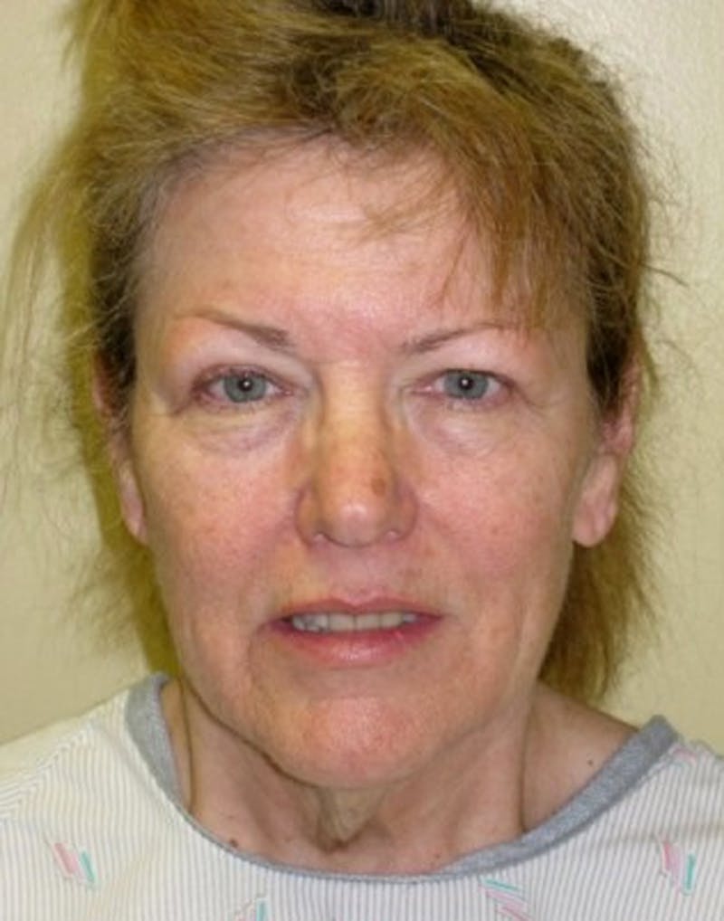 Facelift Before & After Gallery - Patient 174146556 - Image 1