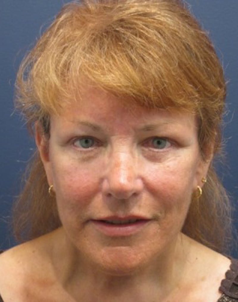 Facelift Before & After Gallery - Patient 174146556 - Image 2
