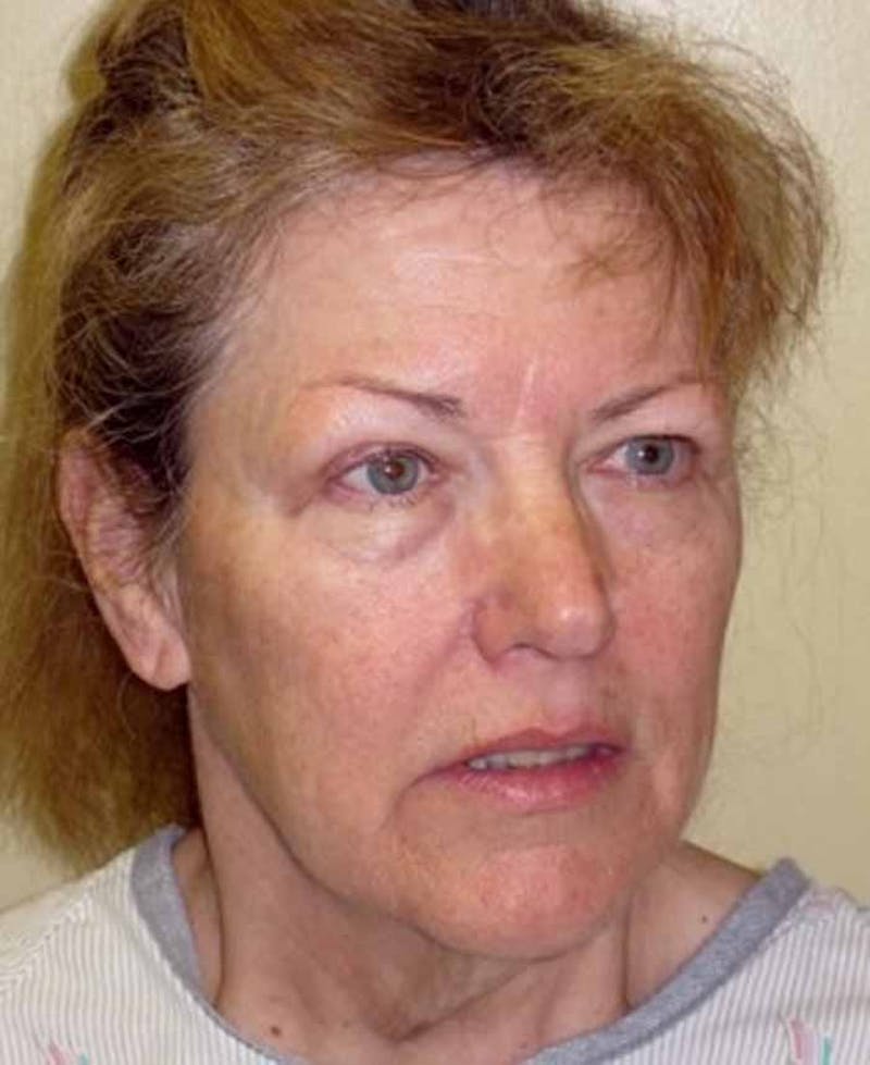 Facelift Before & After Gallery - Patient 174146556 - Image 5