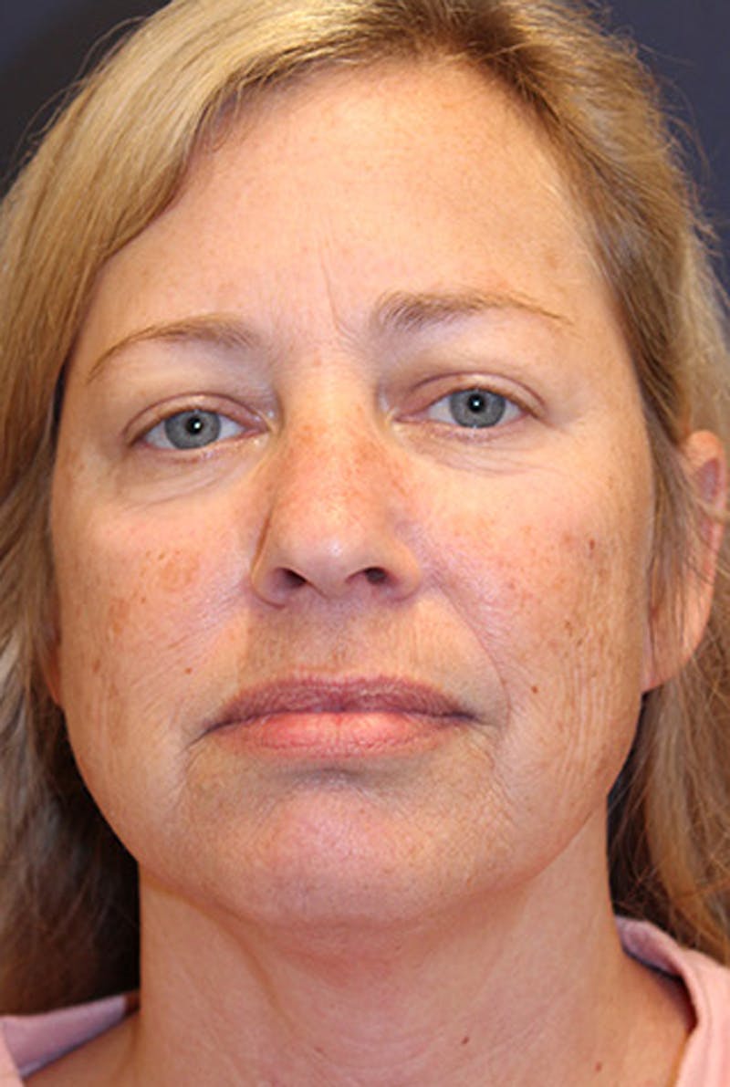 Facial Fat Graft Before & After Gallery - Patient 174146426 - Image 1