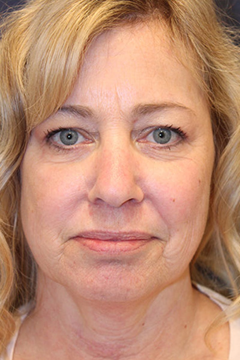 Facial Fat Graft Before & After Gallery - Patient 174146426 - Image 2