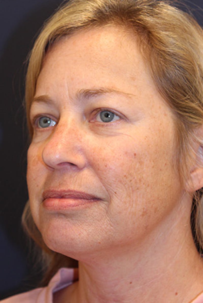Facial Fat Graft Before & After Gallery - Patient 174146426 - Image 3