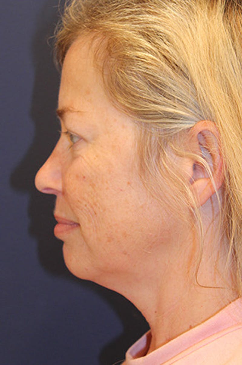 Facial Fat Graft Before & After Gallery - Patient 174146426 - Image 5