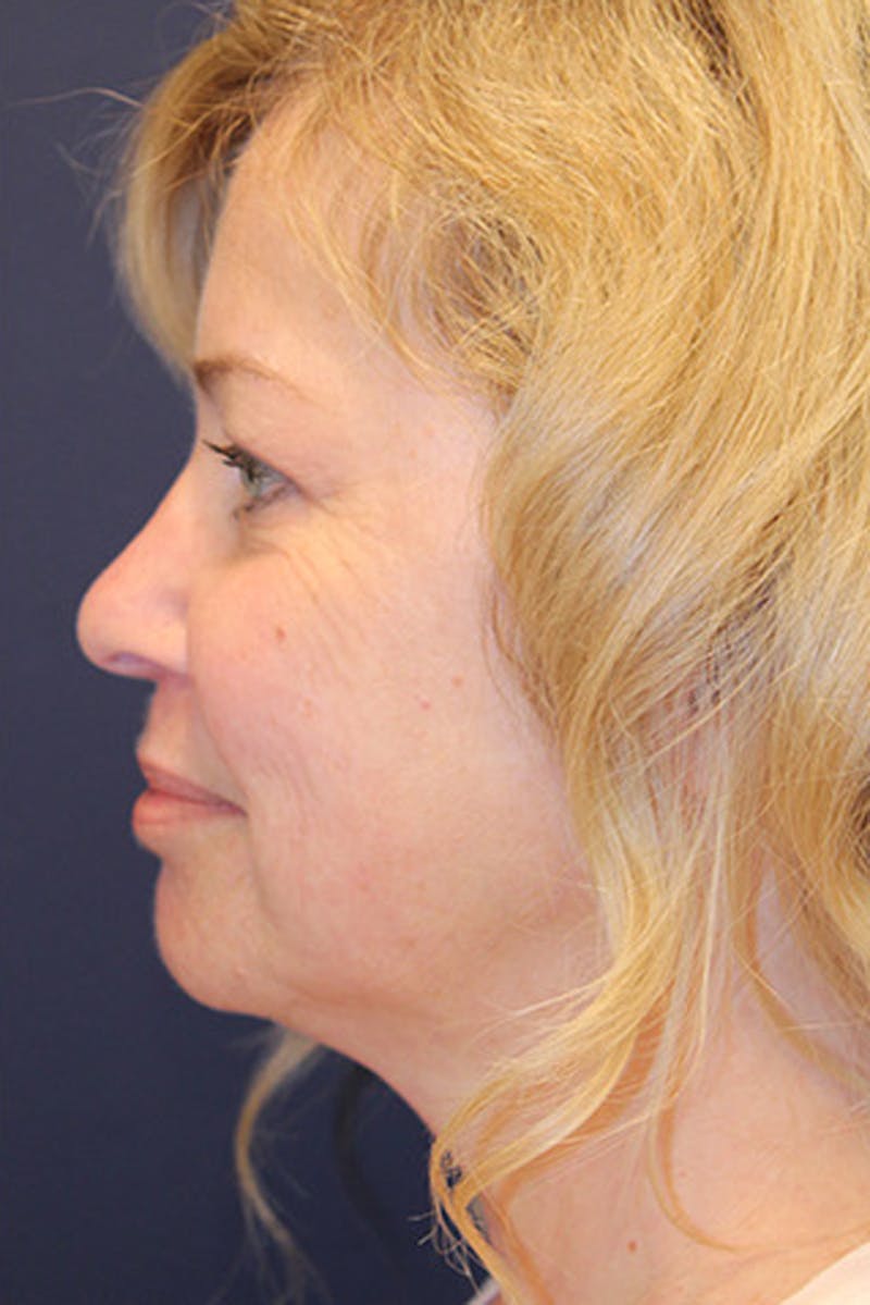 Facial Fat Graft Before & After Gallery - Patient 174146426 - Image 6