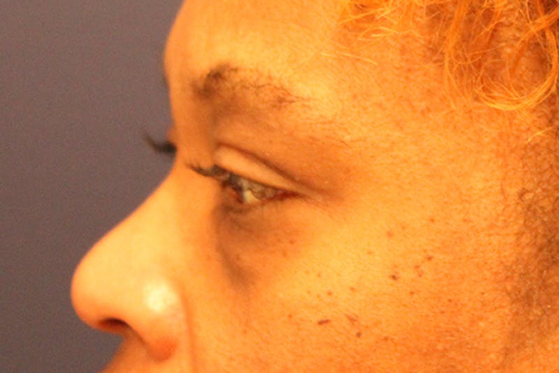 Facial Fat Graft Before & After Gallery - Patient 174146430 - Image 5
