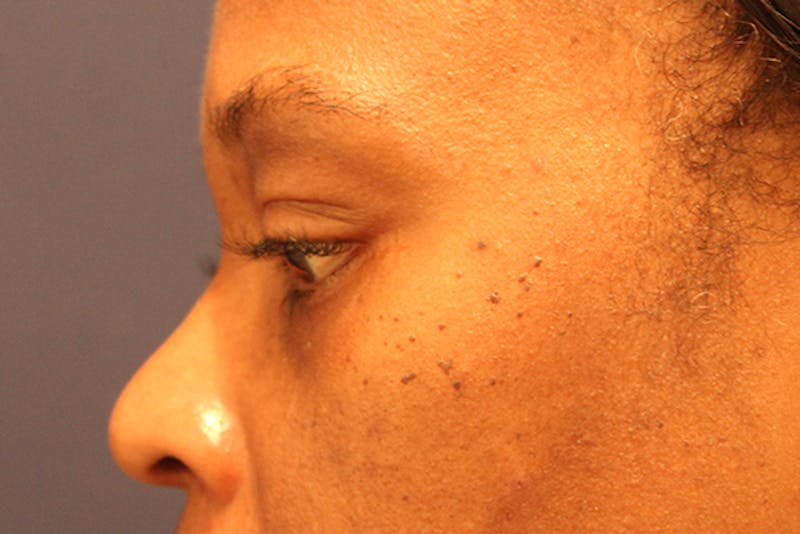 Facial Fat Graft Before & After Gallery - Patient 174146430 - Image 6