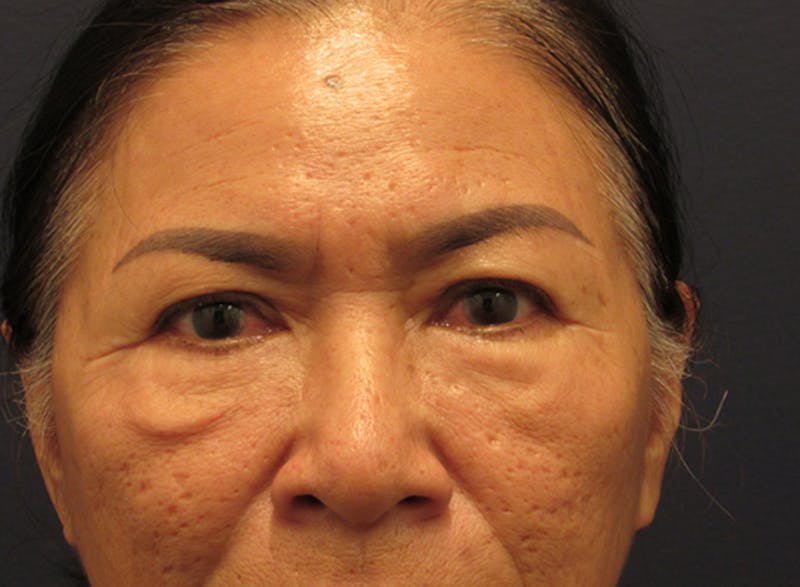 Facial Fat Graft Before & After Gallery - Patient 174146437 - Image 3