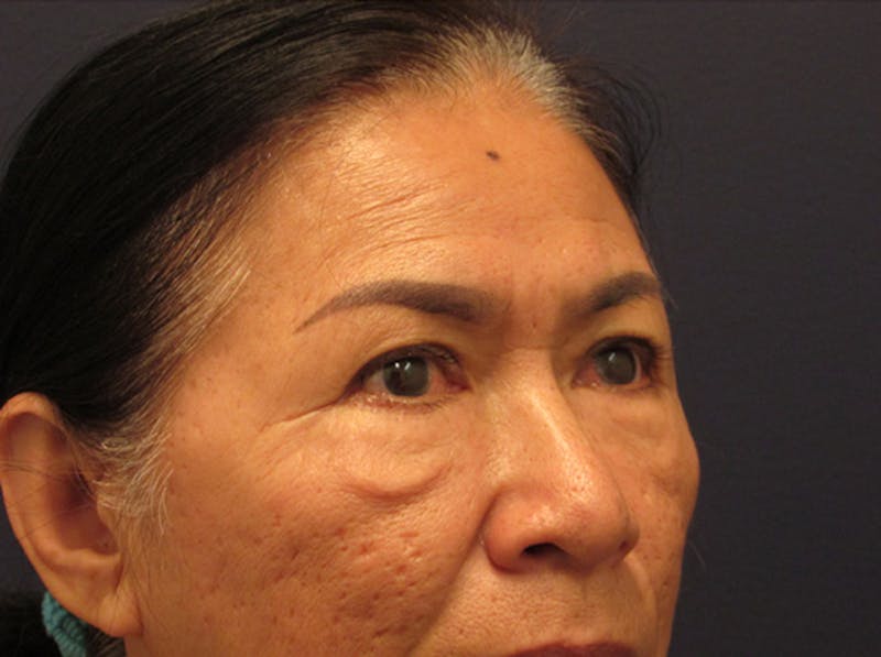 Facial Fat Graft Before & After Gallery - Patient 174146437 - Image 5