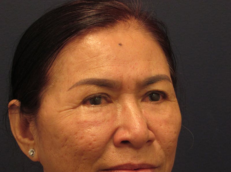 Facial Fat Graft Before & After Gallery - Patient 174146437 - Image 6