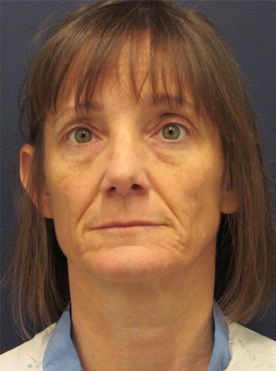 Facial Fat Graft Before & After Gallery - Patient 174146441 - Image 1